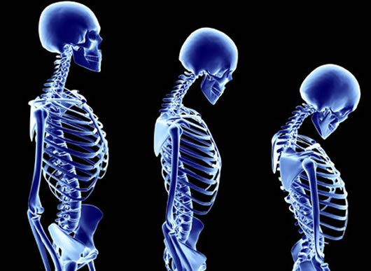 L'ostéoporose et le Jambon Serrano